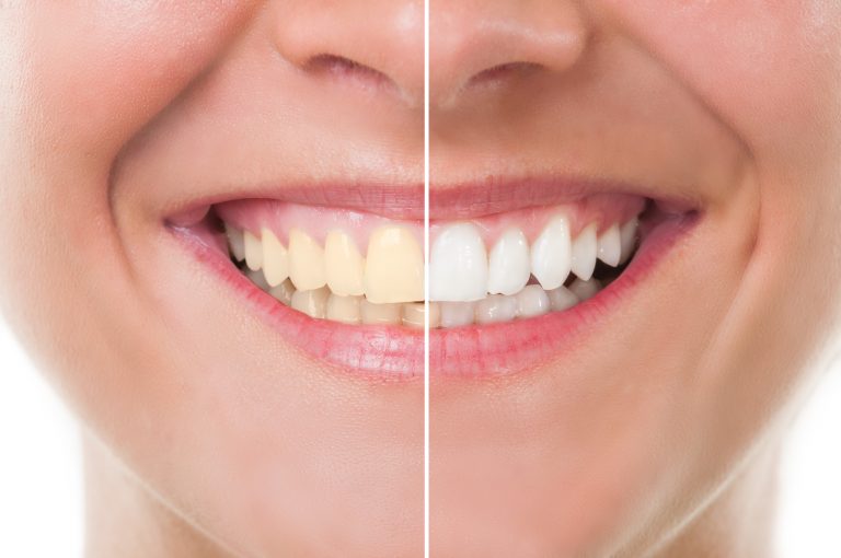 Teeth Whitening Fremont